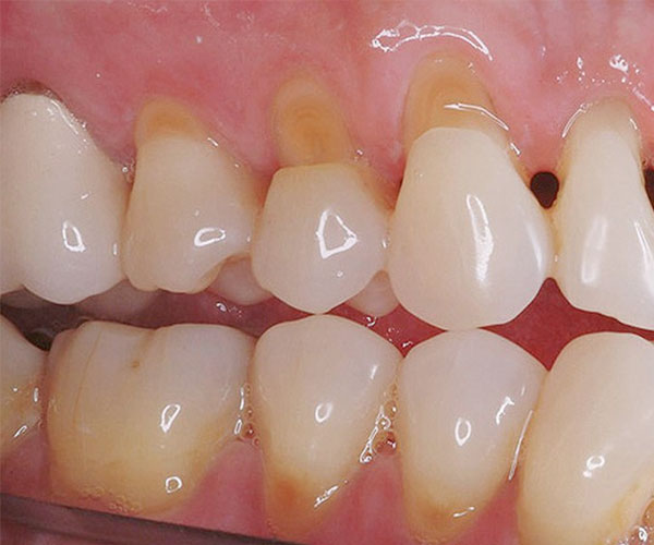 niềng răng hỏng, dấu hiệu nhận biết niềng răng hỏng, những ca niềng răng hỏng, những ca niềng răng bị hỏng, Niềng răng không thành công, niềng răng hỏng dấu hiệu