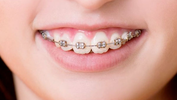 niềng răng hỏng, dấu hiệu nhận biết niềng răng hỏng, những ca niềng răng hỏng, những ca niềng răng bị hỏng, Niềng răng không thành công, niềng răng hỏng dấu hiệu