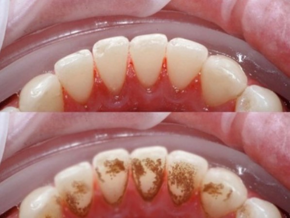 cách chữa vôi răng, cách điều trị vôi răng, cách chữa bệnh vôi răng, cách chữa trị vôi răng