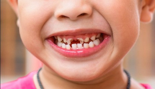 chữa sâu răng cho trẻ 4 tuổi, chữa sâu răng cho bé 4 tuổi, cách chữa sâu răng cho trẻ 4 tuổi