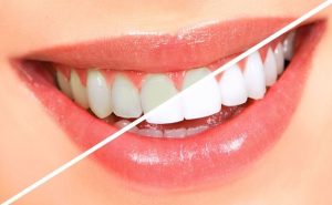 tẩy trắng răng có tốt không, tẩy trắng răng laser có tốt không, tẩy trắng răng có tốt hay không, tẩy trắng răng nhiều có tốt không