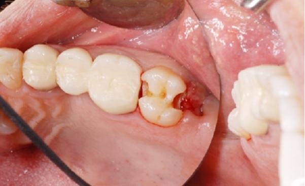 nhổ răng sâu số 8 hàm trên, nhổ răng số 8 hàm trên bị sâu