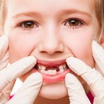Chữa sâu răng cho trẻ 4 tuổi đúng để không ảnh hưởng răng miệng bé sau này 