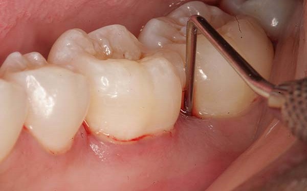 Sưng bọng răng hàm là gì và cách điều trị như thế nào cho hiệu quả?